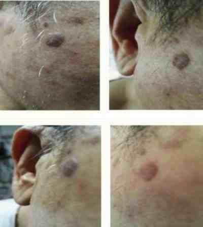 特别报道量子氢氧健康第一人长寿哥(廖永贵)　