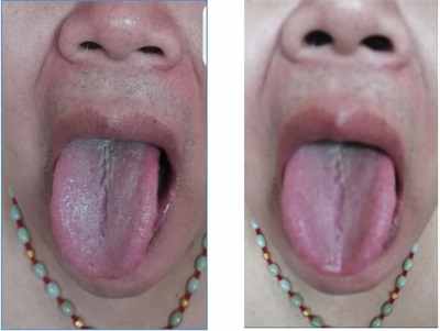 广西中医特色疗法传承导师——梁爱瑟